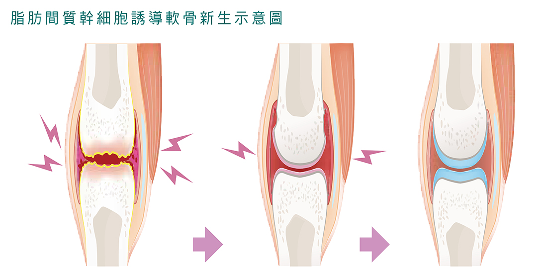 退化性關節炎介紹